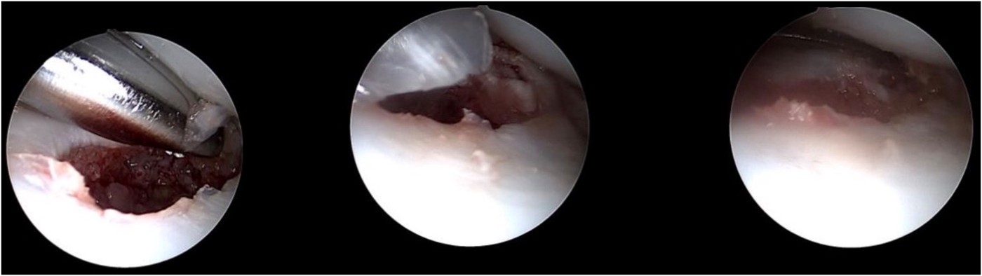 Arthroscopic views of scaphoid nonunion treatment