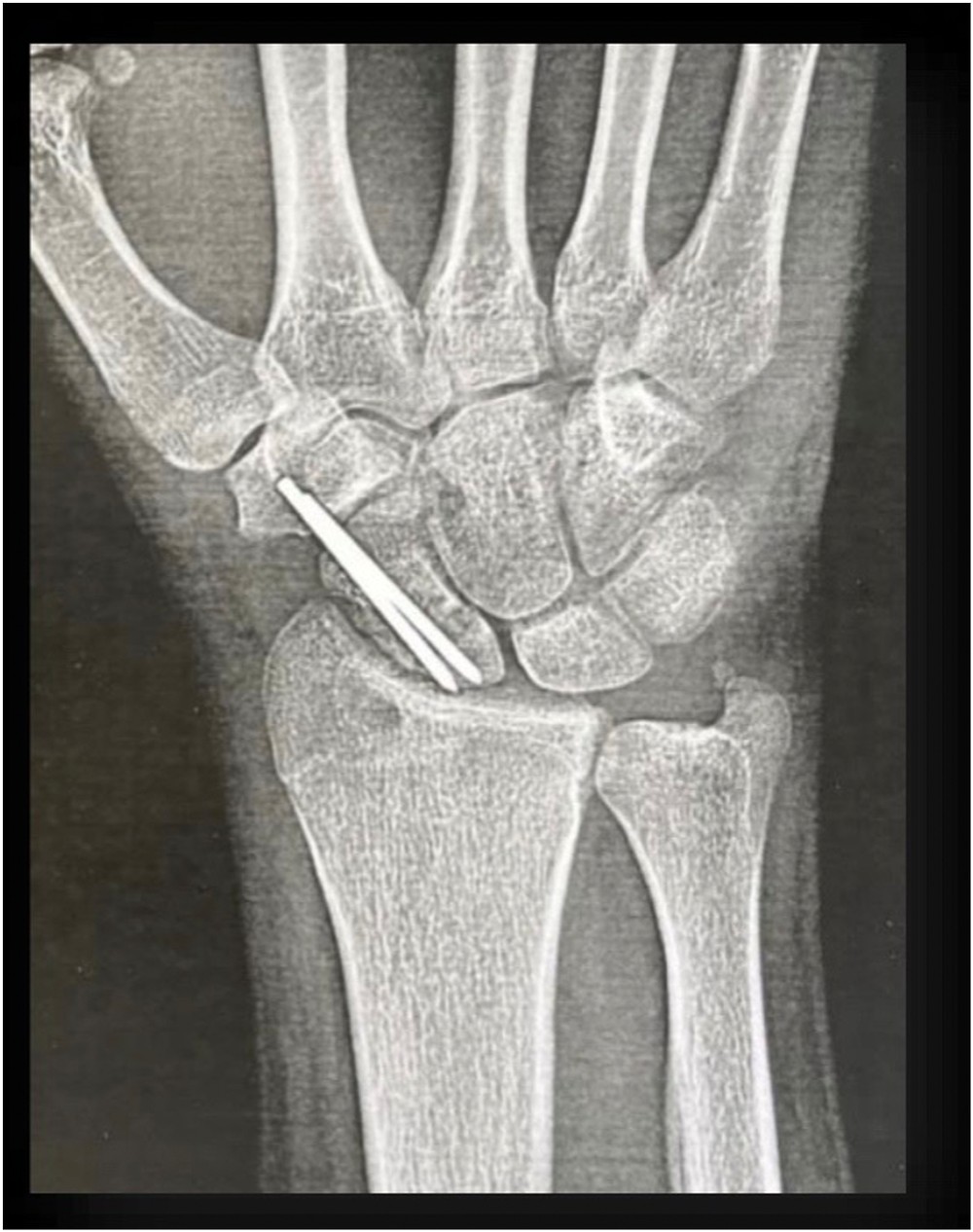 Follow-up radiograph after bone grafting and pinning of a scaphoid nonunion